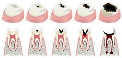 Dr. Shroff | Dolton, IL Dentist | Root Canal Therapy